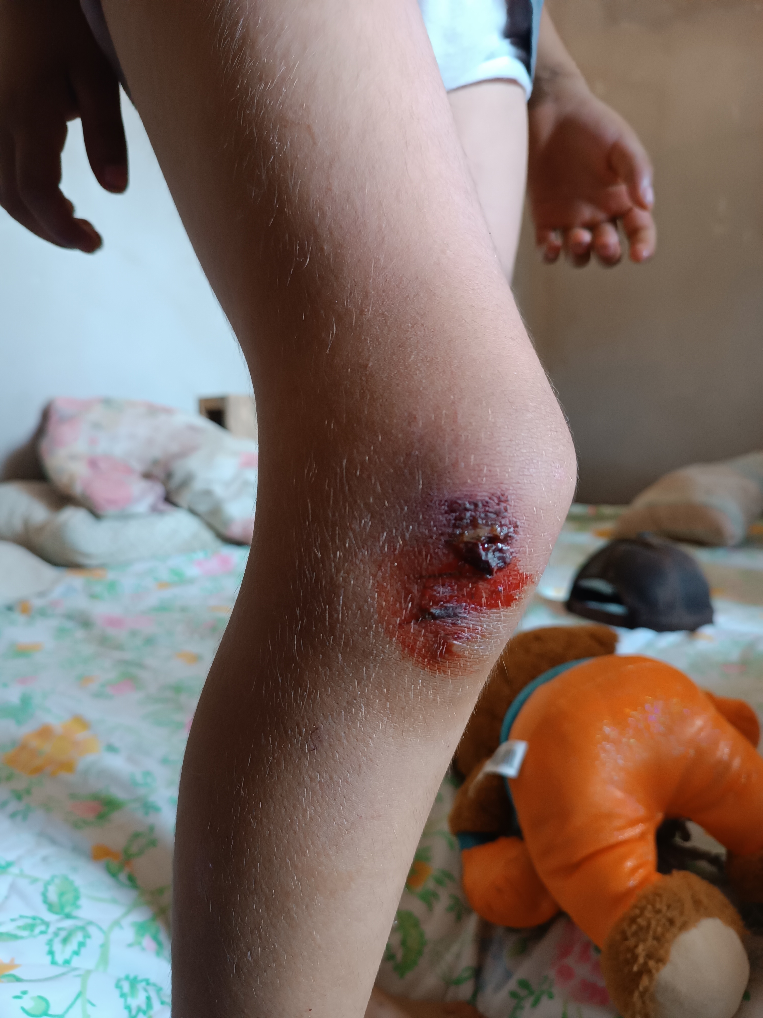 Continuidad de nueva herida